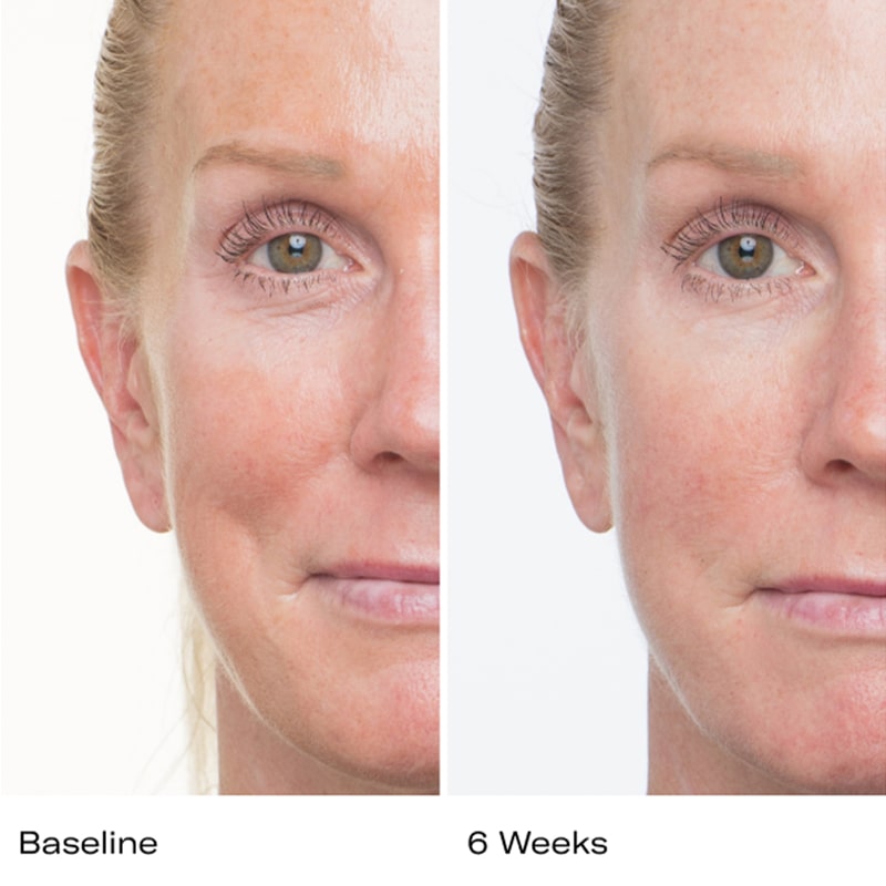 Showing baseline and 6 weeks use results of Le Prunier Plum Beauty Oil on woman
