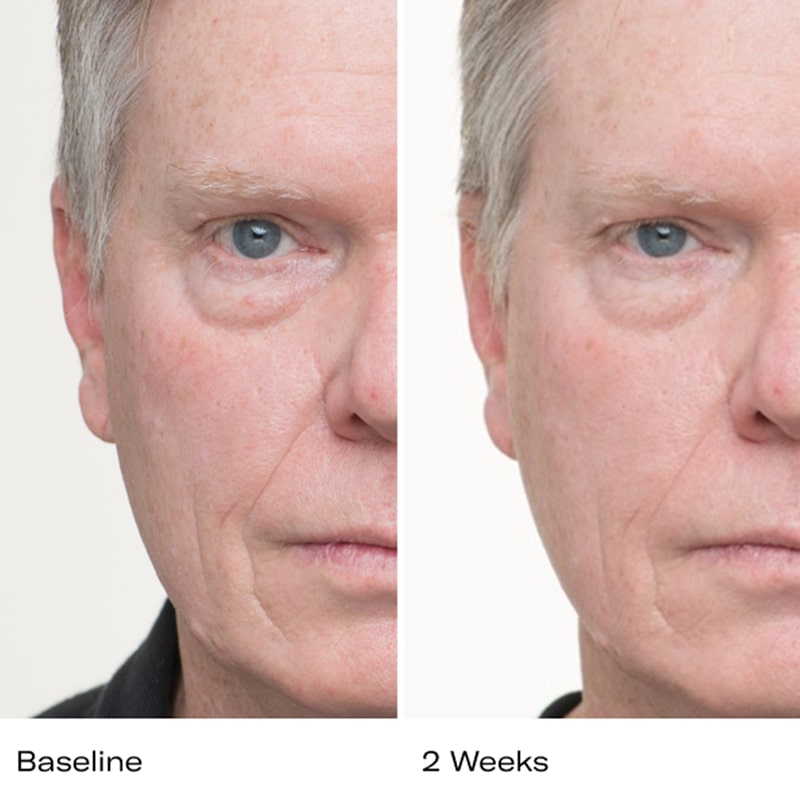 Showing baseline and 2 weeks use results of Le Prunier Plum Beauty Oil on man
